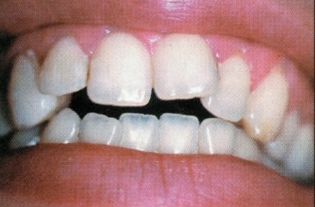 https://www.dentiste-richard-amouyal.com/wp-content/uploads/2016/04/Traitement-dun-diast%C3%A8me-par-facette-dentaire.jpg