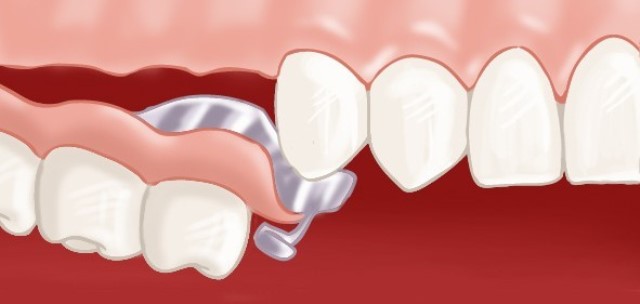 Prothèse dentaire fixe : pont ou bridge